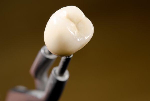 Dental Bridges Crowns