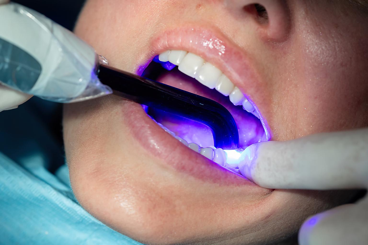 Dental Bonding
