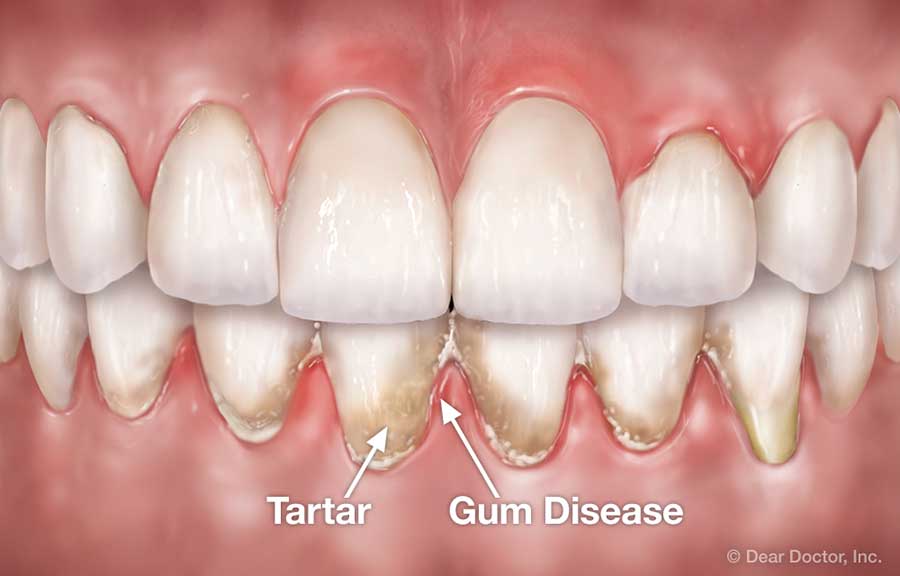 Flap Surgery Root Planing