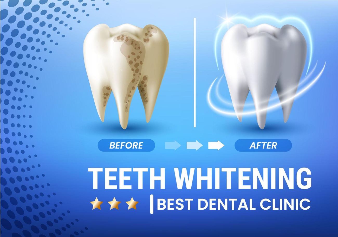 Dental Veneers